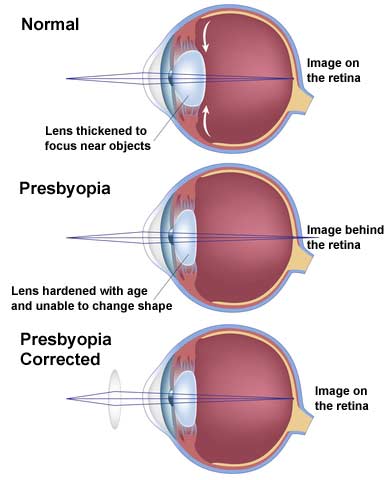 Correction for Presbyopia